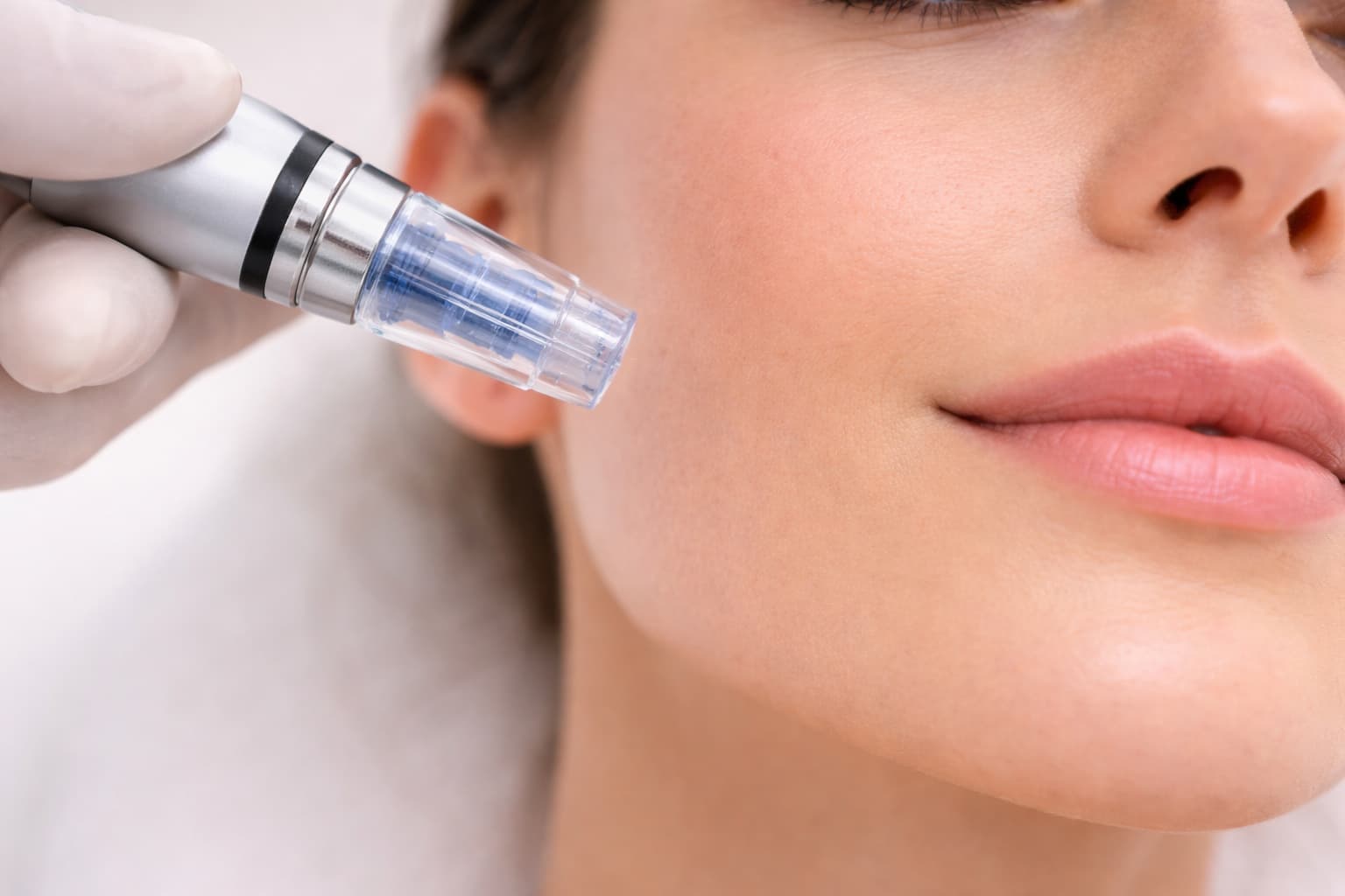 Procedimento de microagulhamento para renovação da pele e estímulo de colágeno